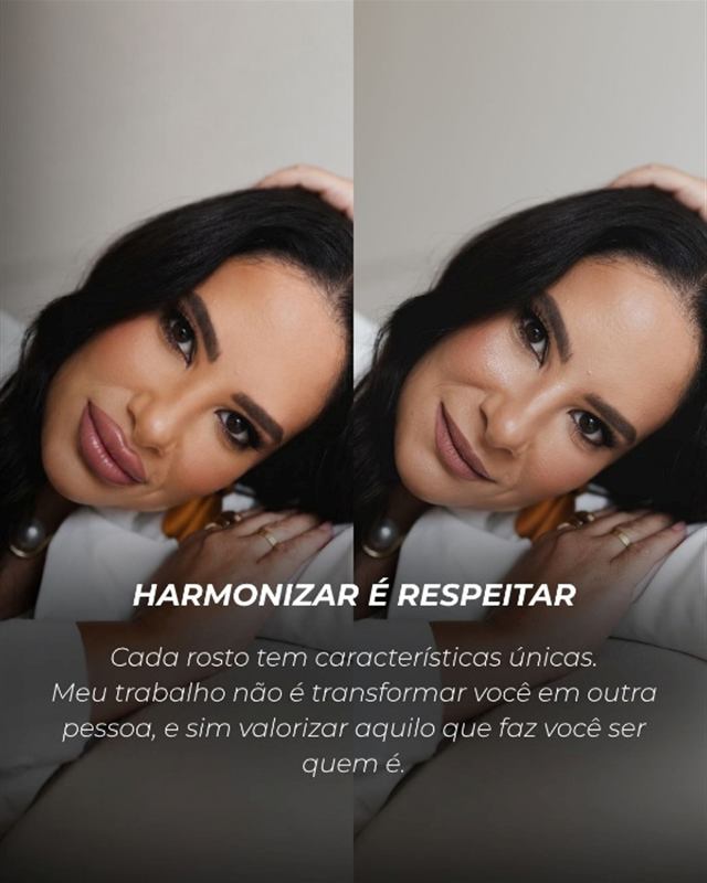 Peça estática de antes e depois de harmonização facial, com o título Harmonizar é respeitar