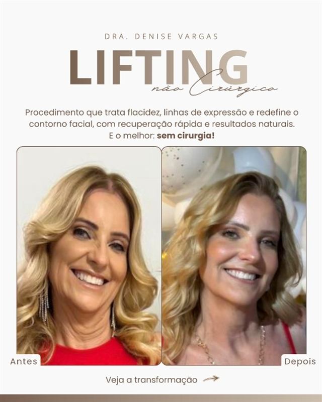 Peça estática da Dra. Denise Vargas sobre lifting não cirúrgico, com fotos de antes e depois